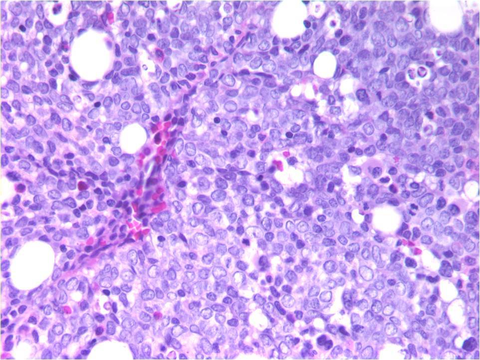 Figure 2. 2-12-10 Bone Marrow Biopsy, H&E, 400x